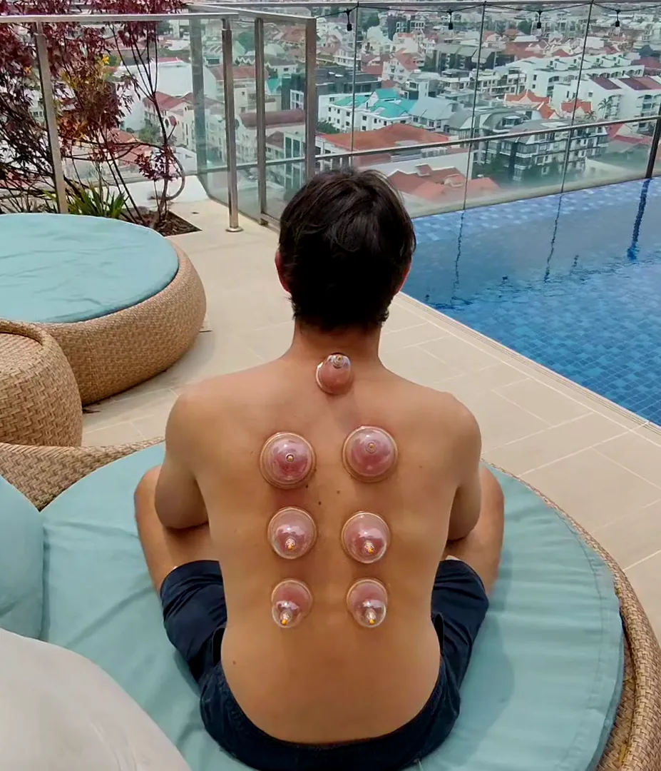 Chinese cupping